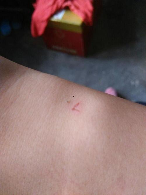 狗咬伤口图片,狗咬伤口紧急处理与预防措施解析